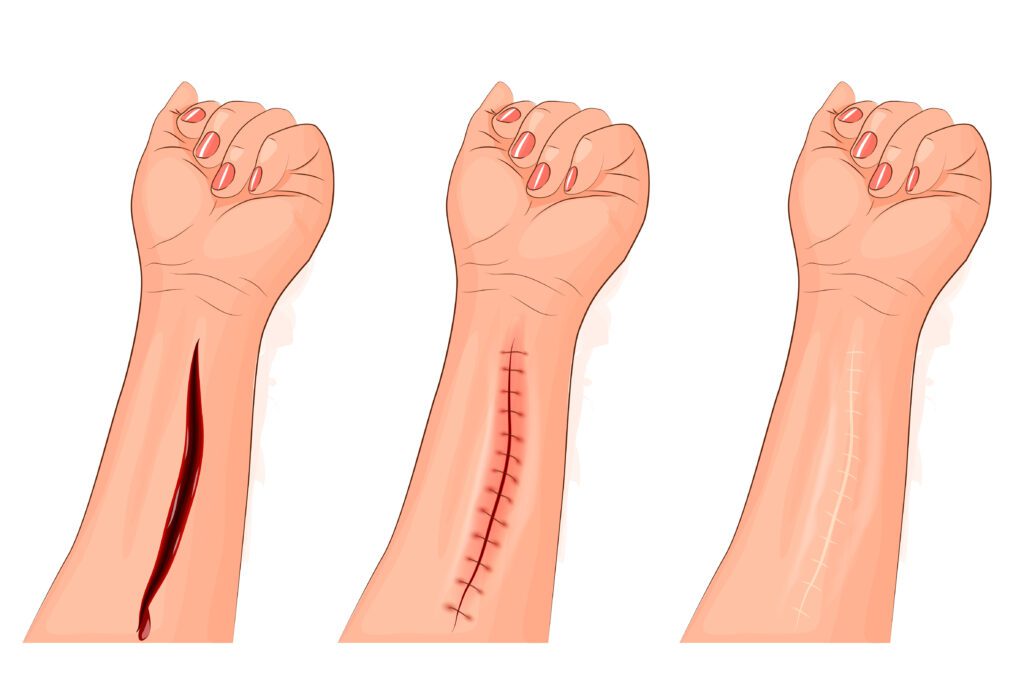 Suture pour survivalistes et randonneurs