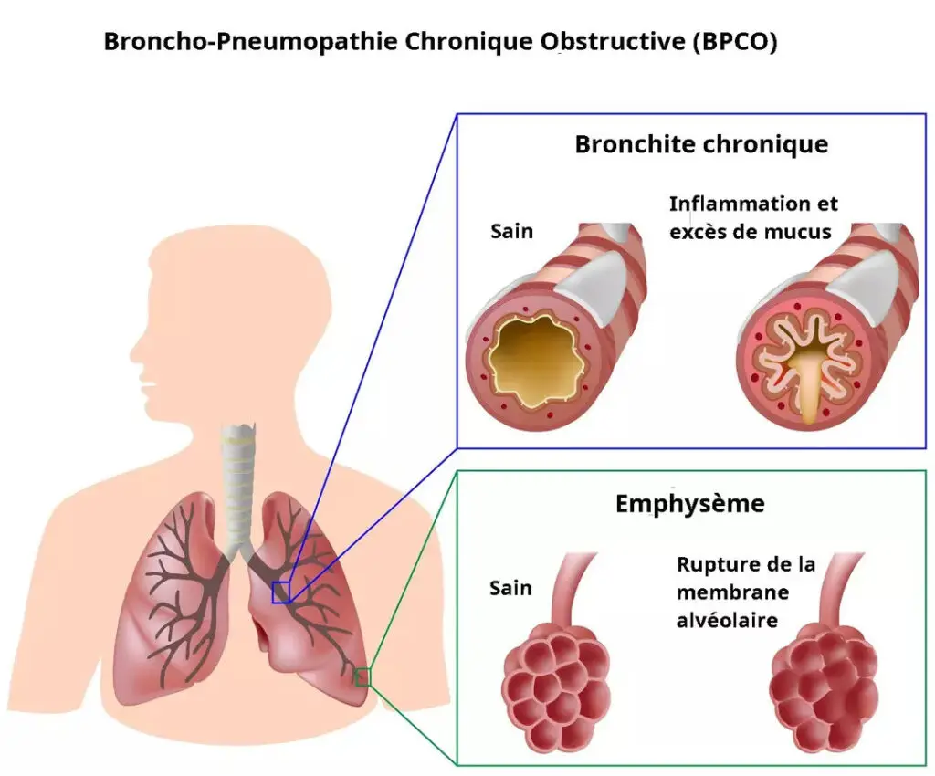 Illustration conséquences BPCO Broncho Pneumopathie Chronique Obstructive