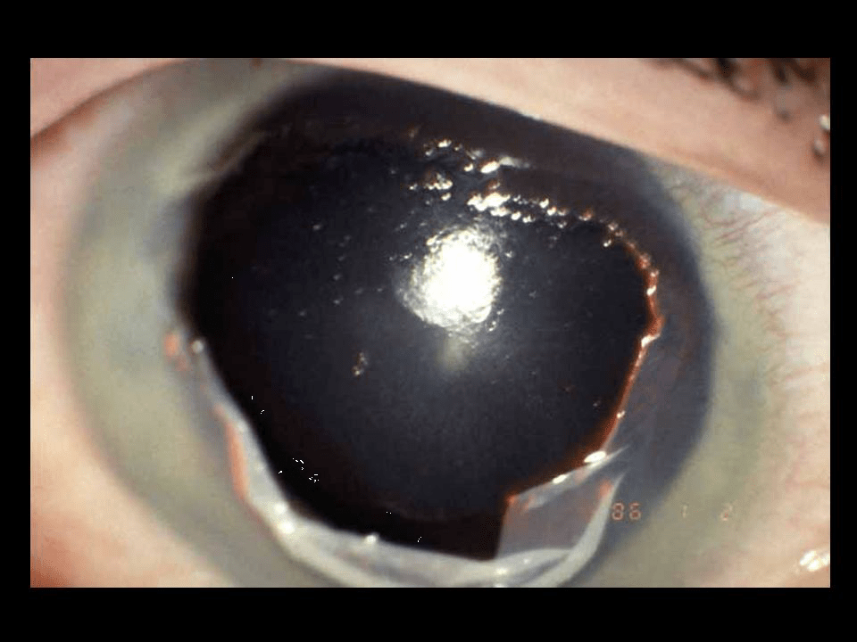 Brulure oculaire que faire, Soins Rando Survie
