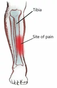 Le syndrome de stress tibial médial soins rando survie