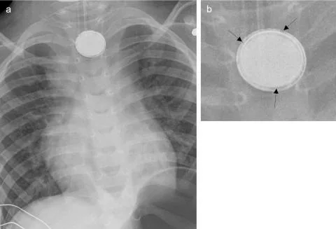 radiographie de face thorax, pile bouton, ingestion