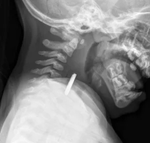 Radiographie ingestion pile bouton, enfant, soins rando survie