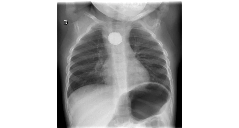 Radiographie bébé avec ingestion de pile bouton