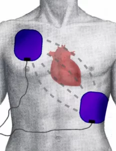 Dessin, où mettre les patchs pour défibrillateur